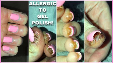 My ALLERGIC REACTION to Methacrylate | Gel polish allergy - YouTube