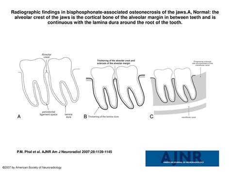 Radiographic Findings In Bisphosphonate Associated Osteonecrosis Of The