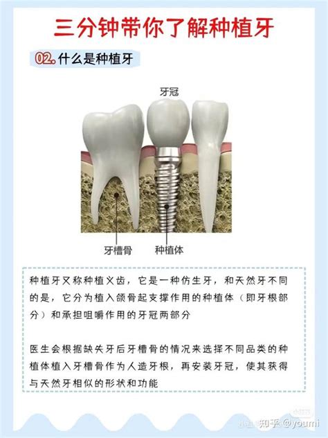 三分钟带你了解种植牙顺义种植牙过程顺义种植牙医院哪里好 知乎