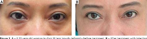 Figure 1 From Tear Trough Deformity Different Types Of Anatomy And