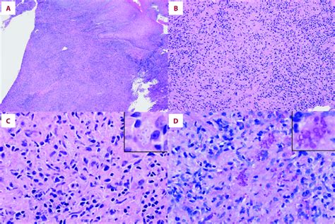 Histologic Features Of Perianal Biopsy A Low Power View 40× Of