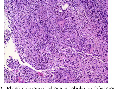 A Case Of Idiopathic Granulomatous Mastitis Associated With Erythema