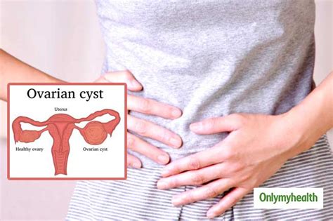 Warning Signs And Symptoms Of Ovarian Cysts Every Woman Must Know