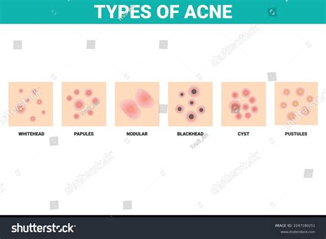 Types of Acne Diagram for Skin Problems Content. - Royalty Free Stock ...