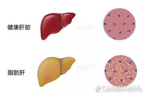 揭秘脂肪肝有多严重到底需不需治疗 知乎