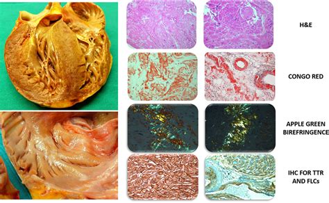 Gross Evaluation Of Unfixed Heart And Histological Characterization