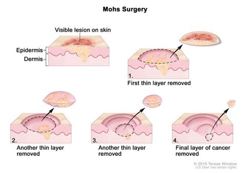 Definition Of Mohs Micrographic Surgery Nci Dictionary Of Cancer