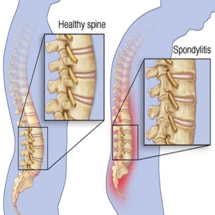 10 best ideas about Viral Arthritis on Pinterest | A well, Heart disease and The two