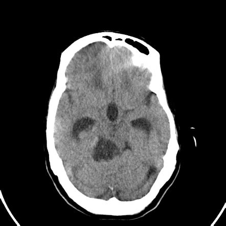 Epidermoid cyst | Radiology Case | Radiopaedia.org