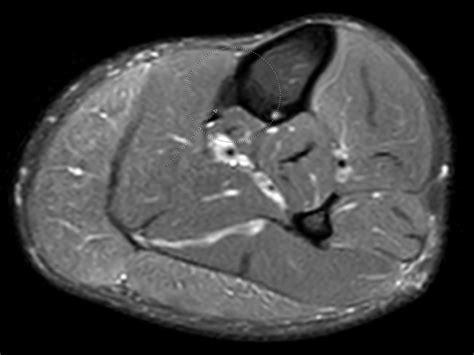 Benoît Rizk On Twitter Periosteal Reaction Seen On Radiographs Prominent Bony Ridge Along