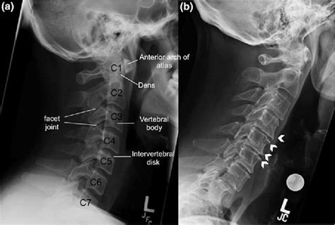 Osteoarthritis X Ray Spine