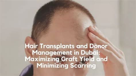 Ppt Hair Transplants And Donor Management In Dubai Maximizing Graft