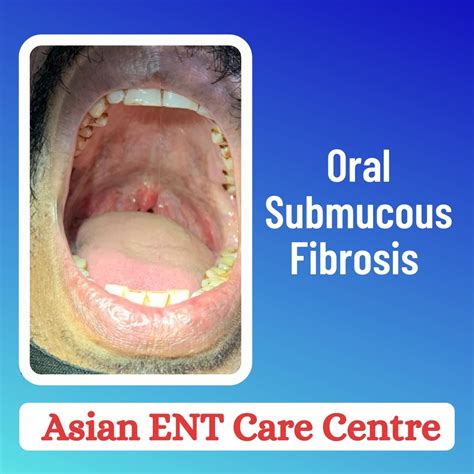 Oral Submucous Fibrosis Treatment Management, 59% OFF