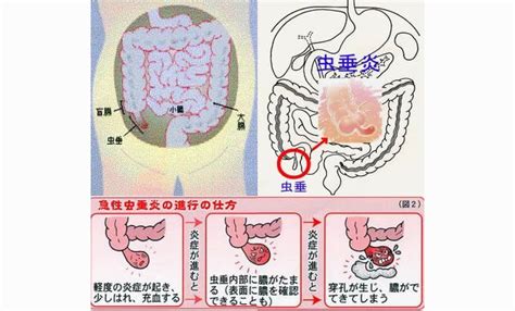 虫垂炎 盲腸 那珂川市の小児科・内科・眼科『江副クリニック』福岡県那珂川市