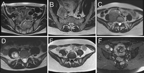 Radiological Presentation Of Sporadic Pelvic Schwannomas AD Axial T2