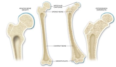 Understanding Osteogenesis Imperfecta: The Fragile Bone Disorder