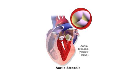 Aortic Stenosis Diagram