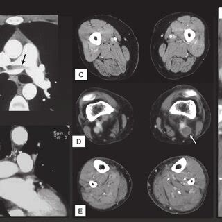 CT Pulmonary Arteriography And Venography CT PAV CT Pulmonary