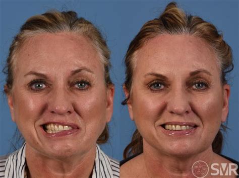 Bells Palsy Before And After Photo Gallery Dallas Tx Shai M Rozen Md Facs