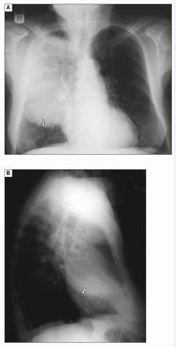 Community Acquired Pneumonia Thoracic Key