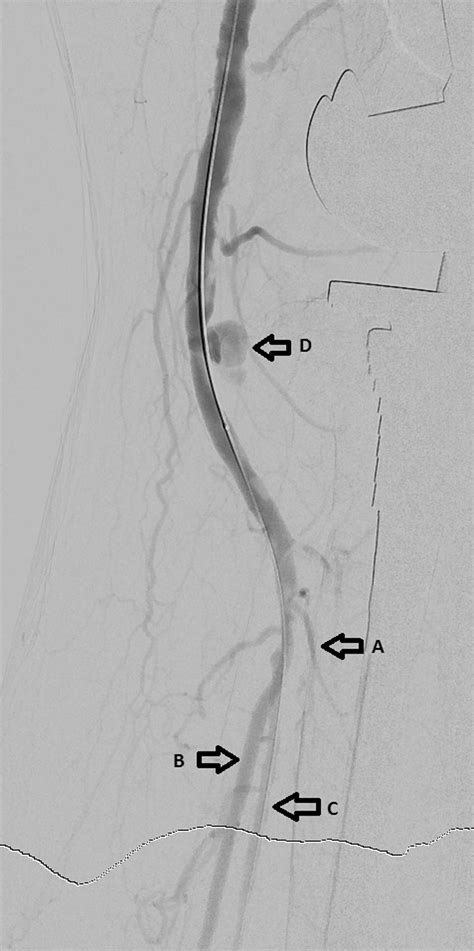 Totally Endovascular Management Of Popliteal Artery Occlusion And