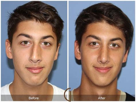 Male Rhinoplasty Before After Photos From Dr Kevin Sadati