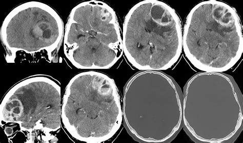 Gliosarcoma