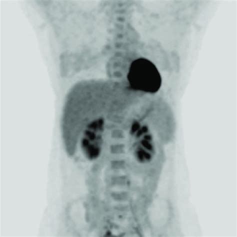 Positron Emission Tomography Pet Maximum Intensity Projection Mip