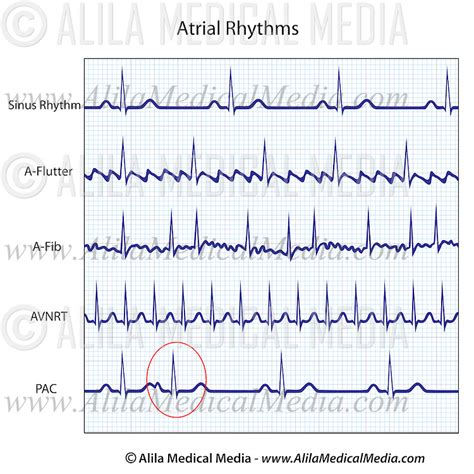 Ecg Rhythms Atrial Flutter The Great Mimic Hot Sex Picture