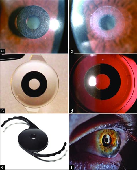 A Kamra Corneal Inlay Showing Grade Haze B The Corneal Haze