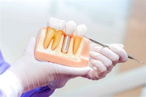 Why Are More People Getting Dental Implants? - Smile Solutions