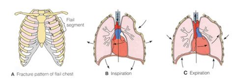 Nremt Trauma Flashcards Quizlet