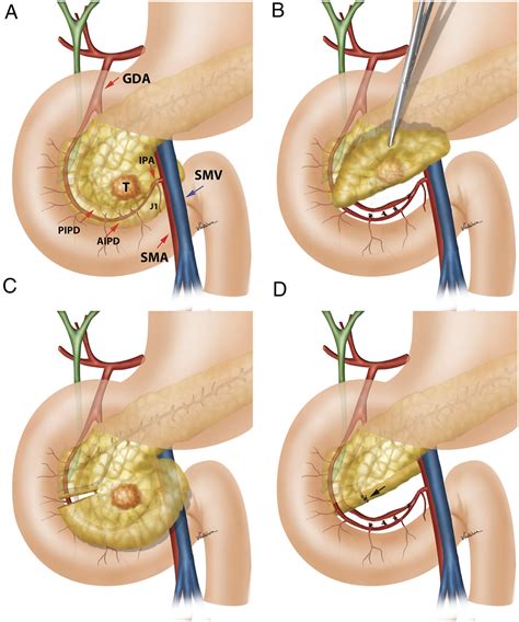 Pancreas Anatomy Uncinate