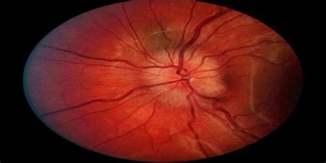 Papilledema - Assignment Point