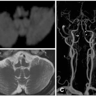 Brain MRI Of The Patient With Medial Medullary Infarction A