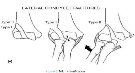 Lateral Condyle Fracture Milch