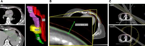 Frontiers Auxiliary Structures Assisted Radiotherapy Improvement For