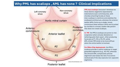 mitral valve anatomy  aml lacks scallops  pml