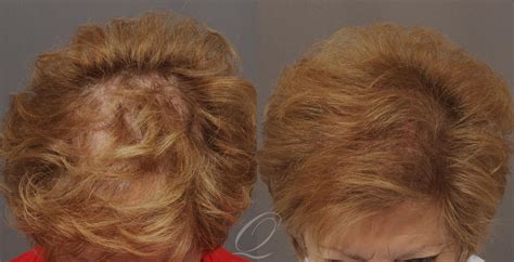 Female FUT Hair Transplant Before After Photo Gallery Serving