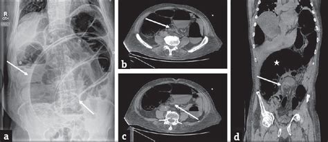 Large Bowel Obstruction In The Emergency Department Imaging Spectrum