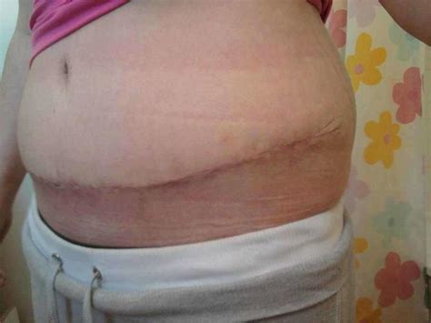 Pictures Of Tummy Tuck Scars 6 Tummy Tuck Prices Photos Reviews Info Qanda