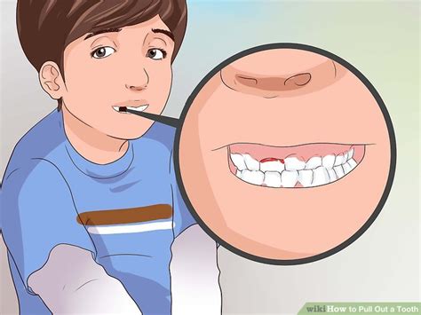 3 Ways To Pull Out A Tooth Wikihow