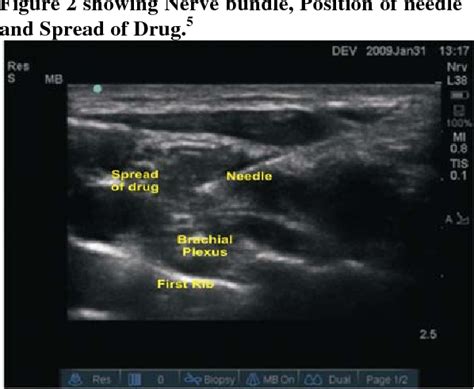 PDF Comparative Study Of Supraclavicular Brachial Plexus Block By