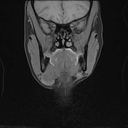 Submandibular Schwannoma Image Radiopaedia Org