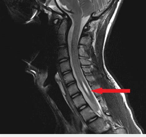 Pre-operative MRI spine. Note the short segment syringomyelia. It ...