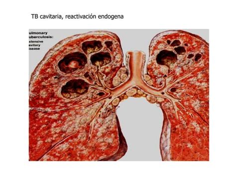 Tuberculosis Pulmonar Ppt