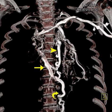 Superior Vena Cava Syndrome Collateral Circulation