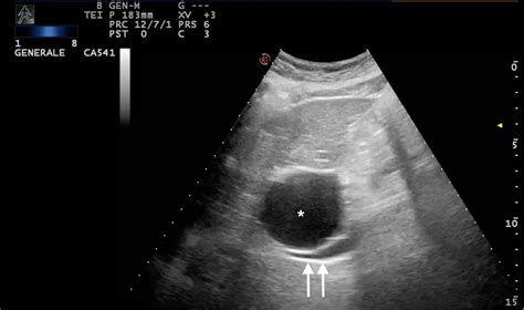 Giant Hepatic Cyst Determining Secondary Budd Chiari Syndrome