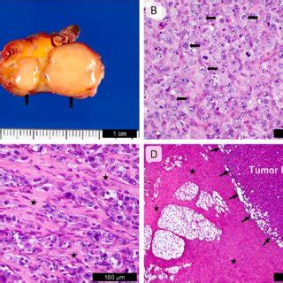 Macroscopic And Pathological Images Of The Anaplastic Lymphoma