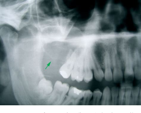 Figure 1 From Unicystic Ameloblastoma Of The Maxillary Sinus Pitfalls